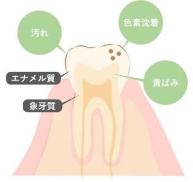 歯はどうして痛むの？